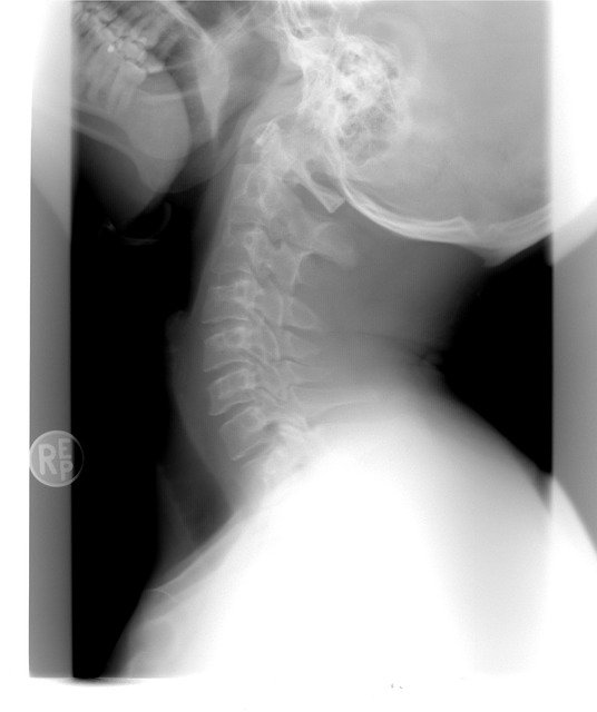 X-rays of the neck
